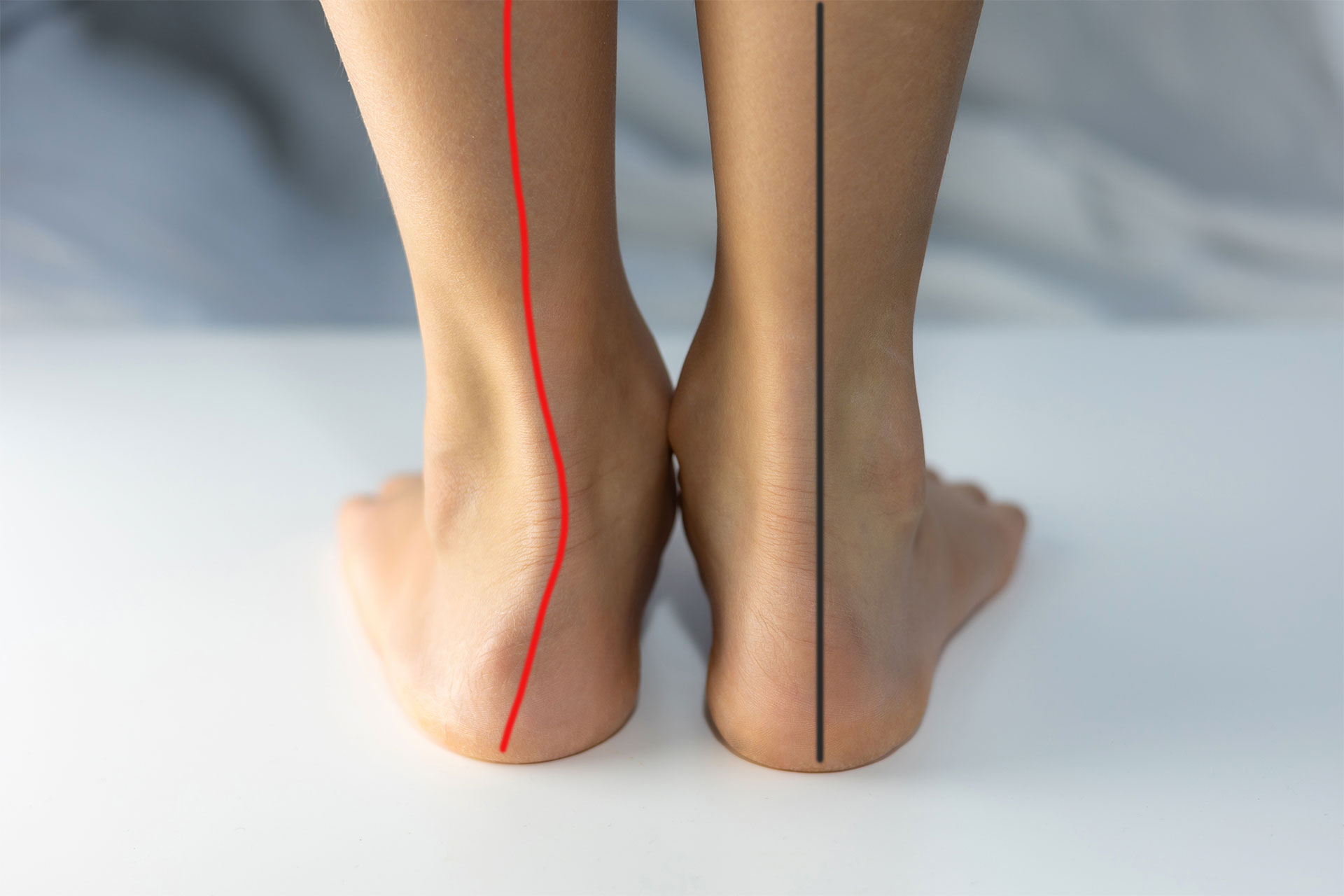 Unterschiedlich lange Beine